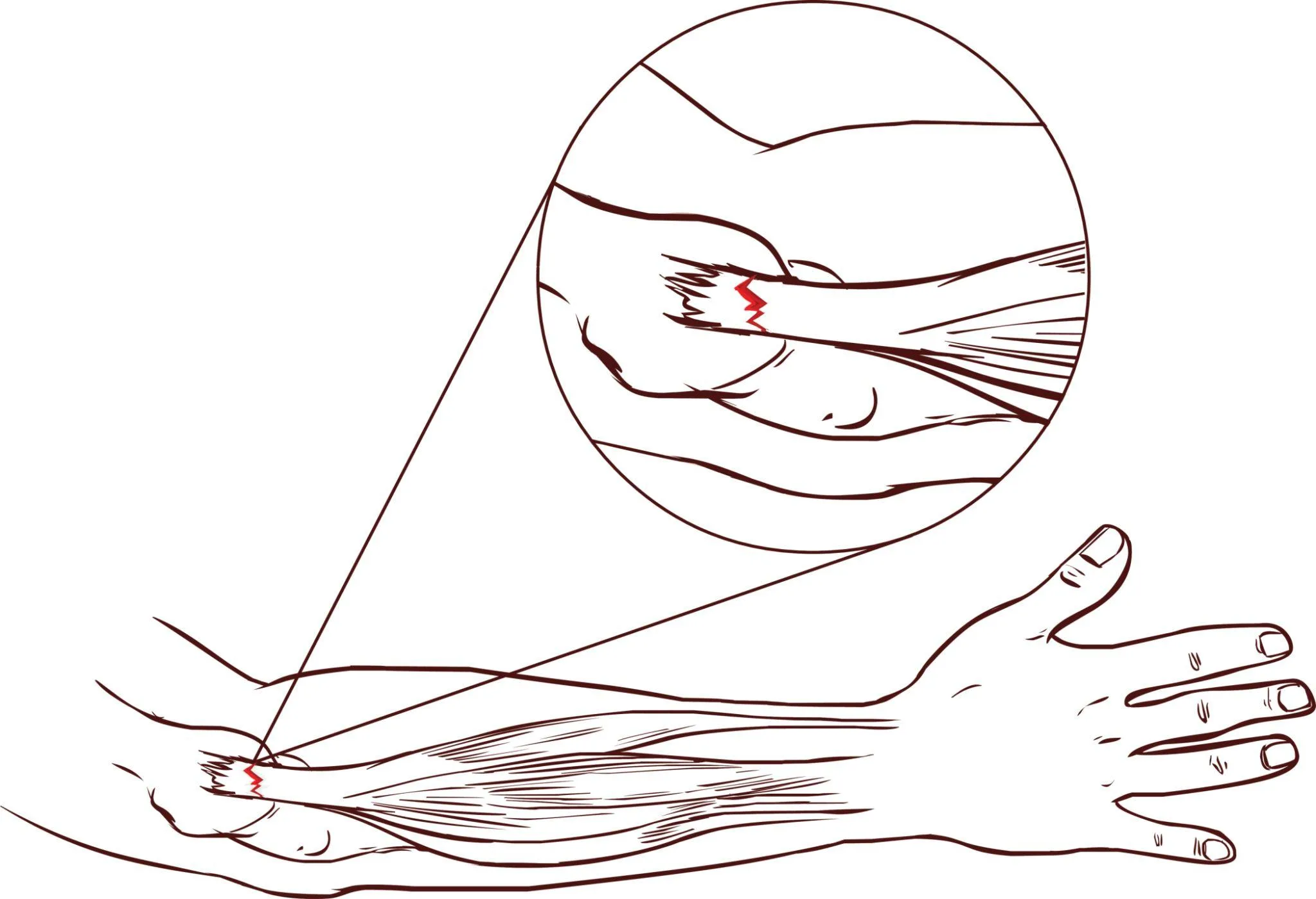 Illustrasjon av tennisalbue – seneskade ved lateral epikondyl på utsiden av albuen