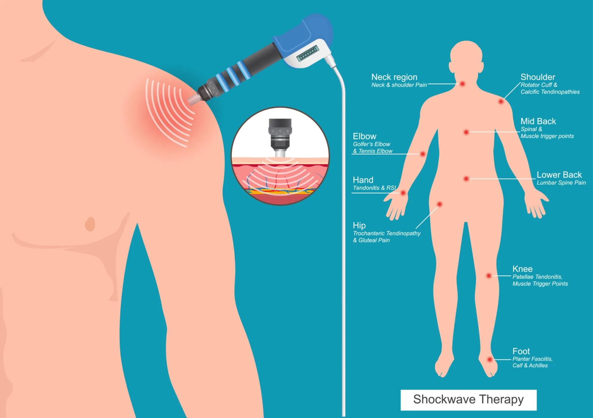 Trykkbølgebehandling (shockwave therapy) – bruksområder for skulder, nakke, rygg, albue, hofte, kne og fot
